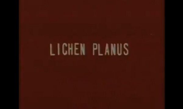 Lichen Planus