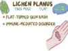 Lichen Planus Causes, Symptoms, Diagnosis, Treatment, Pathology