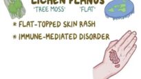 Lichen Planus Causes, Symptoms, Diagnosis, Treatment, Pathology