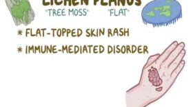Lichen Planus Causes, Symptoms, Diagnosis, Treatment, Pathology