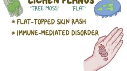Lichen Planus Causes, Symptoms, Diagnosis, Treatment, Pathology