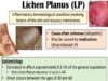 Lichen Planus Purple Skin Lesions Causes, Signs_Symptoms
