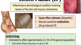 Lichen Planus Purple Skin Lesions Causes, Signs_Symptoms