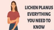 Unlocking the Mystery of Lichen Planus Everything You Need to