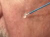 Watch Learn Cryosurgery