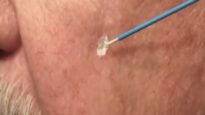 Watch Learn Cryosurgery