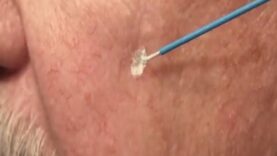 Watch Learn Cryosurgery