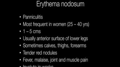 What is Erythema Nodosum – Pathology mini tutorial