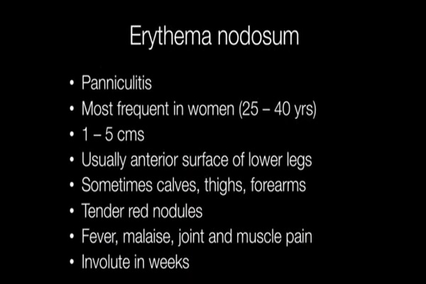 What is Erythema Nodosum – Pathology mini tutorial