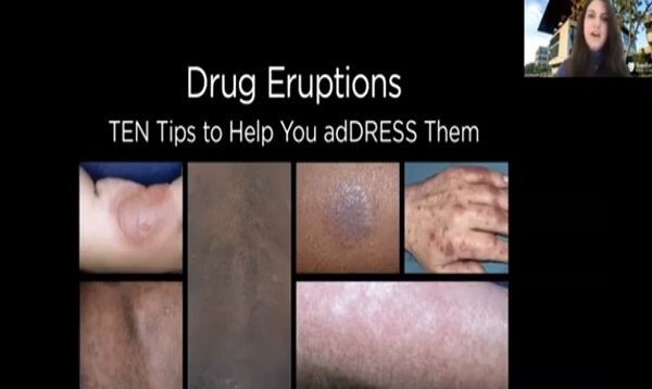 Drug Eruptions_ TEN tips to help you adDRESS them