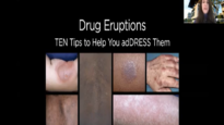 Drug Eruptions_ TEN tips to help you adDRESS them