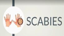 SCABIES, Causes, Signs and Symptoms, Diagnosis and Treatment