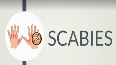 SCABIES, Causes, Signs and Symptoms, Diagnosis and Treatment